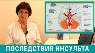 Последствия инсульта головного мозга, восстановление после инсульта