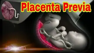 Placenta Previa