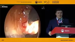 ЛЕЧЕНИЕ НЕСОСТОЯТЕЛЬНОСТИ ЭЗОФАГОГАСТРОАНАСТОМОЗА С ИСПОЛЬЗОВАНИЕМ ЭУС-ТЕХНОЛОГИЙ
