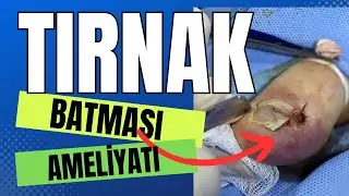 TIRNAK BATMASI AMELİYATI