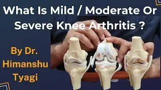 Knee Arthritis - Mild / Moderate/ Severe - What is it ?