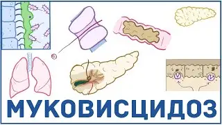 Муковисцидоз - причины, симптомы, диагностика, лечение