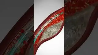 Saving Hearts: One Stent at a Time. See Angioplasty & Stent Placement 