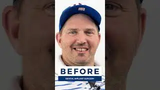 Smile With Confidence Again! Before and After Dental Implant Transformation 🤩 