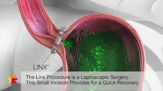 Linx Reflux Management System