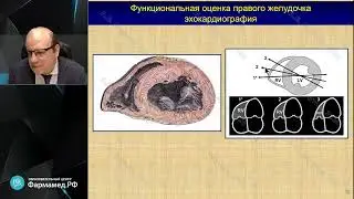 ОПЖСН и легочная гипертензия в МКС Баутин А.Е.