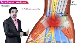 Carpal tunnel syndrome Anatomy Animation