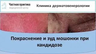 Покраснение и зуд мошонки при кандидозе