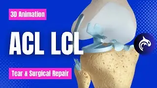 Watch How ACL LCL Tears Are Repaired - 3d Animation Explained