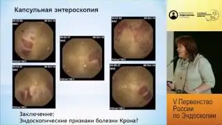 Язвенная энтеропатия со стенозированием: болезнь крона или ...?