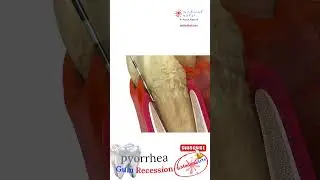 Gum Recession 🦷 Pyorrhea 🦷 Medical 3D Animation 