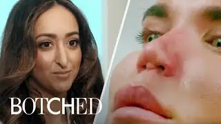 The Most Intense Nose Surgeries From Botched | E!