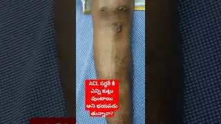 ACL సర్జరీ కిఎన్ని కుట్లు వుంటాయిఅని భయపడుతున్నారా? 