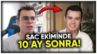 SAÇ EKTİRDİĞİME PİŞMAN MIYIM?  - Saç Ekimi Soru Cevap