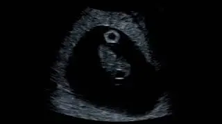 What Can You See At An 8 Week Baby Scan?