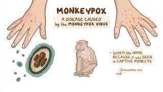 Monkeypox Explained