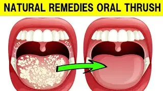 How To Treat Oral Thrush With Natural Remedies