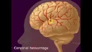 Cereberal Stroke - Neurology