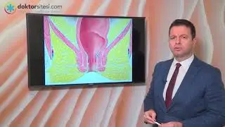 Anal fistül nedir? Tedavisi nasıl yapılır?