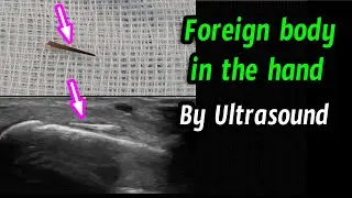 Foreign body in the hand by ultrasound