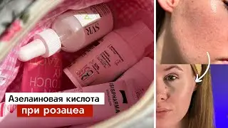 Азелаиновая кислота - как выбрать, как использовать? | Розацеа и акне