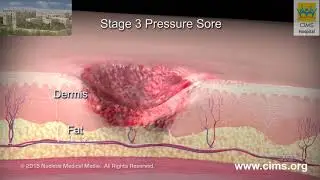 Pressure Sores – CIMS Hospital