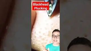 Crazy BLACKHEAD PLUCK - Painstaking Blackhead Removal #shorts