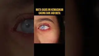GADIS INI JADI BUTA MATANYA KEMASUKAN CACING 