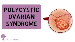 Polycystic Ovarian Syndrome