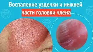 😡 Воспаление уздечки и нижней части головки члена. Клинический случай №1223