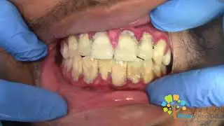 Dental Cleaning to remove heavy tartar🦷.  【Young Male first cleaning】