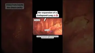 Collapsed Lung Re-expanding via Needle Decompression