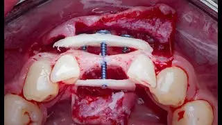 khoury technique for rebuilding severe horizontal bone defect