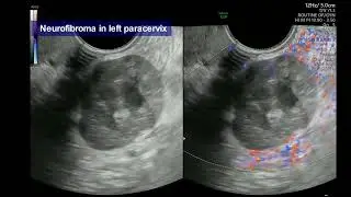 Videoclip from #uogjournal presents characteristics of benign, retroperitoneal, pelvic PNSTs