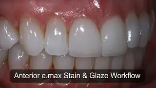 Anterior e.max Stain and Glaze Workflow for the CAD/CAM Dentists