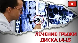 ВЫЛЕЧИЛИ ГРЫЖУ ДИСКА L4-L5