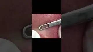 Dr Pimple Popper's Gnarly Pops! Part 1