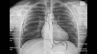 Normal chest x ray (position) كيفية التأكد من صحة الاشعة السينية