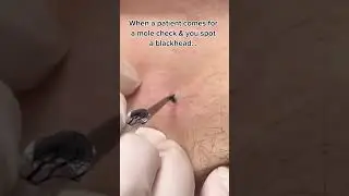 Nice Dilated Pore of Winer 