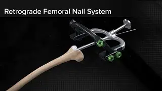 Retrograde Femoral Nail System Surgical Technique