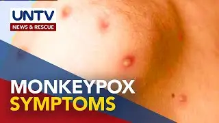 What you need to know about monkeypox symptoms