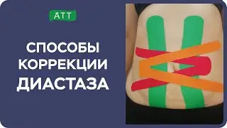 Диастаз прямых мышц живота. Эстетическое тейпирование. Упражнения при диастазе. Мастер класс.