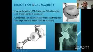 Dual Mobility Components in Total Hip Replacement