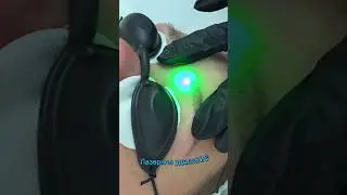 Лазерное удаление татуажа бровей