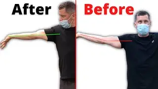 How To Get Full Elbow Extension Back After Injury