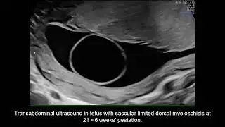 Case of closed dysraphism undergoing CSF leakage after cyst rupture, benefiting from prenatal repair