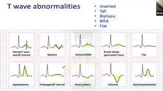 T wave in ECG by Dr. M Atahar Ali sir