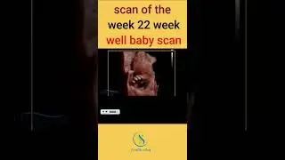 scan of the week 22 week well baby scan#pregnancy #ultrasound #baby #birth