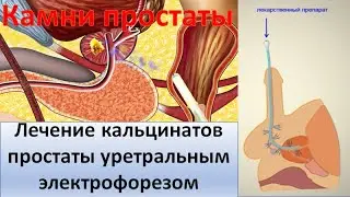 Лечение кальцинатов простаты уретральным электрофорезом