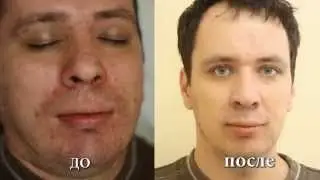 Лечение угревой сыпи ЛАЗЕРОМ / ЛЕЧЕНИЕ АКНЕ